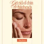Get Rid of Chin Whiteheads – Clear Skin Routine, Targeted Treatments & Prevention